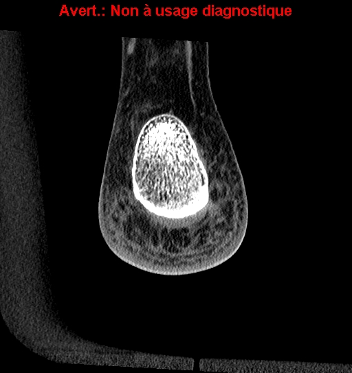 Baxter neuropathy (Radiopaedia 25988-26125 Coronal non-contrast 49).jpg