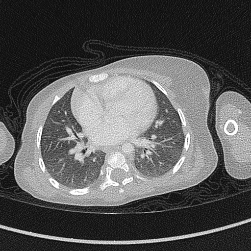 Beckwith-Wiedeman syndrome with bilateral Wilms tumors (Radiopaedia 60850-68629 Axial lung window 37).jpg