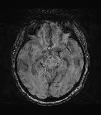 File:Behavioral variant frontotemporal dementia and late onset schizophrenia (Radiopaedia 52197-58083 Axial SWI 30).png