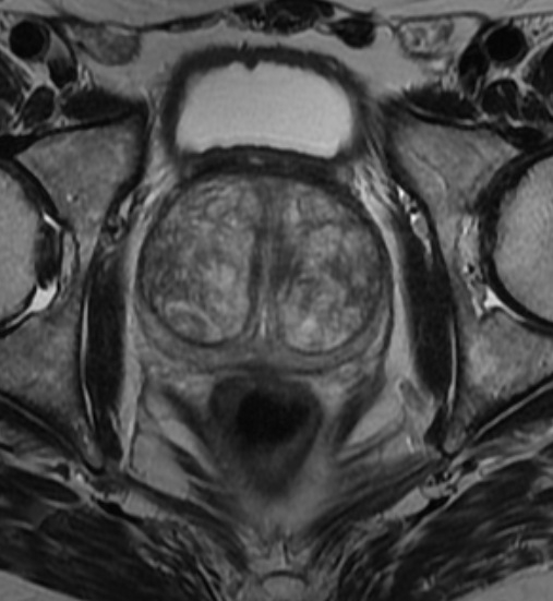 File:Benign prostatic hyperplasia (Radiopaedia 14165).jpg