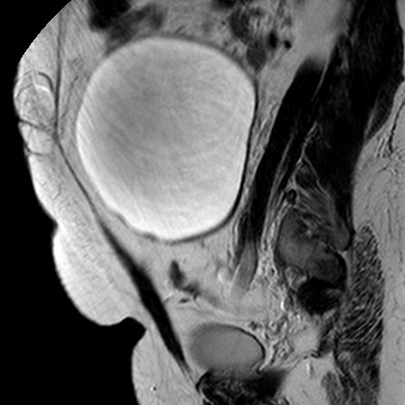 File:Benign seromucinous cystadenoma of the ovary (Radiopaedia 71065-81300 Sagittal T2 8).jpg