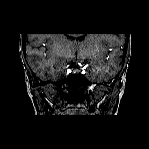 File:Berry aneurysm of the terminal internal carotid artery (Radiopaedia 88286-104918 Coronal TOF 41).jpg