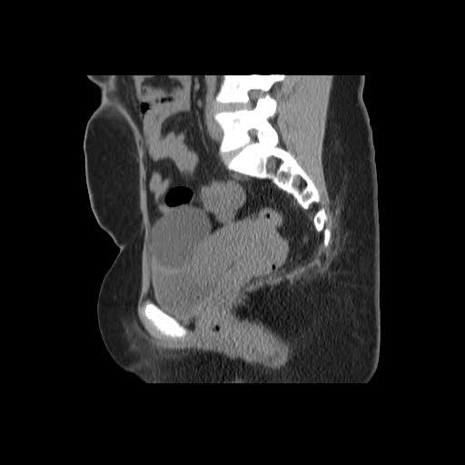 File:Bicornuate uterus- on MRI (Radiopaedia 49206-54296 A 12).jpg