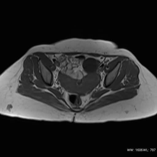 File:Bicornuate uterus- on MRI (Radiopaedia 49206-54297 Axial T1 8).jpg