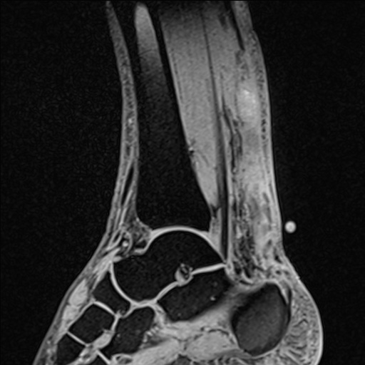 Bilateral Achilles tendon complete tear (Radiopaedia 81344-95051 Sagittal WE - Right 61).jpg