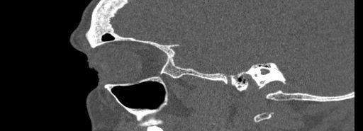 Bilateral Ectopic Infraorbital Nerves (Radiopaedia 49006-54084 Sagittal bone window 43).jpg