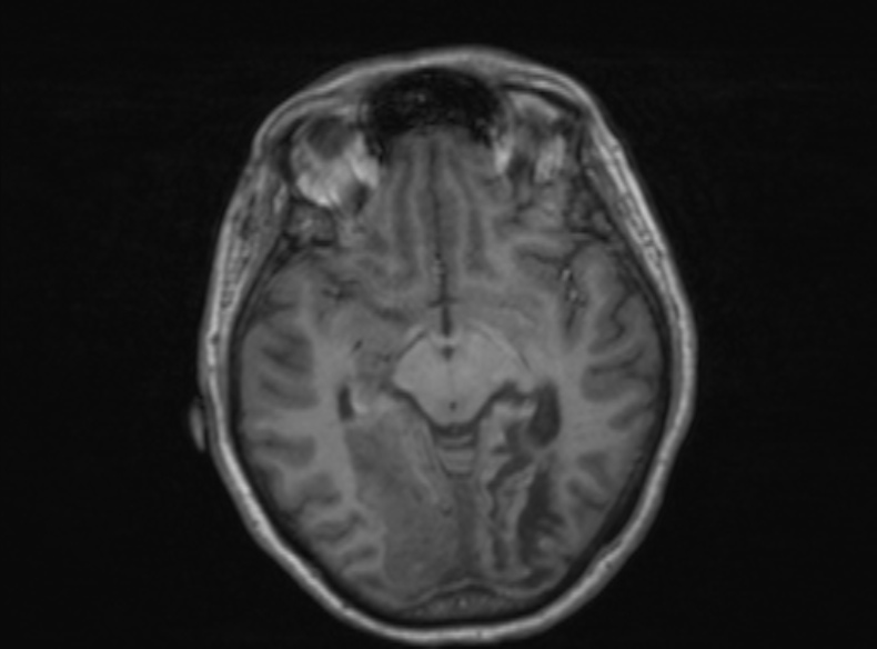 File:Bilateral PCA territory infarction - different ages (Radiopaedia 46200-51784 Axial T1 258).jpg
