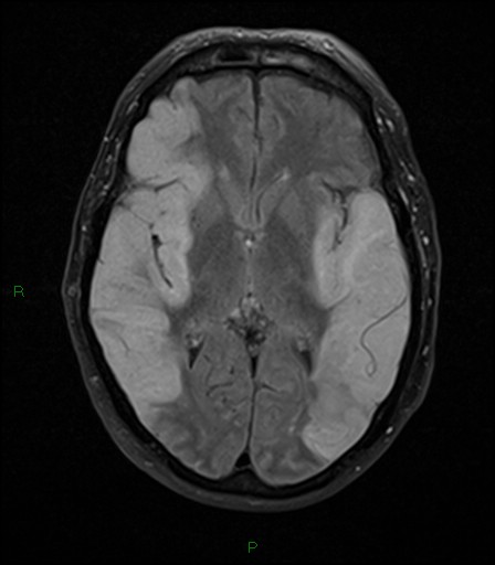 File:Bilateral acute middle cerebral artery territory infarcts (Radiopaedia 77319-89402 Axial FLAIR 12).jpg