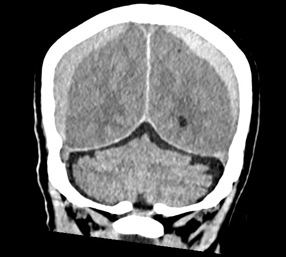 Bilateral acute on chronic subdural hematomas (Radiopaedia 78466-91146 Coronal non-contrast 51).jpg