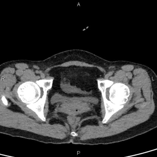 Bilateral adrenal gland hyperenhancement in pancreatitis (Radiopaedia 86642-102753 Axial non-contrast 105).jpg