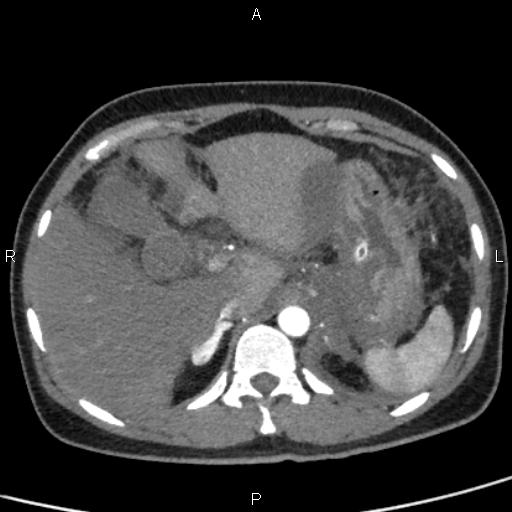 Bilateral adrenal gland hyperenhancement in pancreatitis (Radiopaedia 86642-102753 B 28).jpg