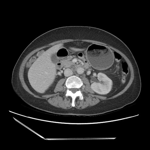 Bilateral adrenal granulocytic sarcomas (chloromas) (Radiopaedia 78375-91007 A 55).jpg
