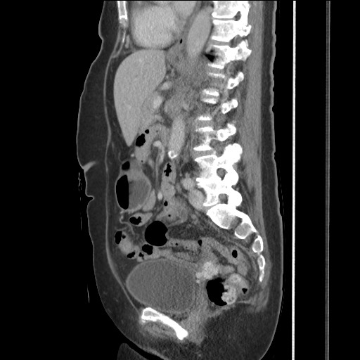 Bilateral adrenal granulocytic sarcomas (chloromas) (Radiopaedia 78375-91007 C 80).jpg