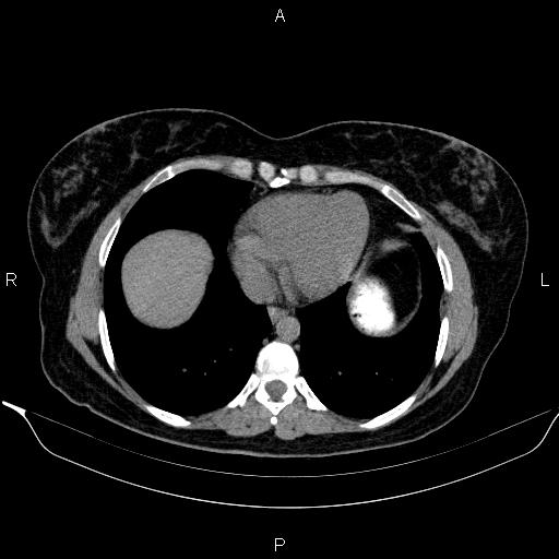 File:Bilateral adrenal myelolipoma (Radiopaedia 63058-71535 Axial non-contrast 5).jpg