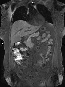 Bilateral adrenal myelolipoma (Radiopaedia 63058-71537 Coronal T1 fat sat 70).jpg