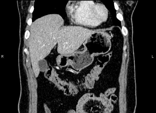 Bilateral benign adrenal adenomas (Radiopaedia 86912-103124 D 12).jpg