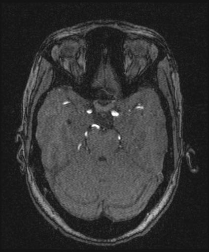 Bilateral carotid body tumors and right glomus jugulare tumor (Radiopaedia 20024-20060 Axial MRA 66).jpg