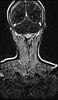 File:Bilateral carotid body tumors and right glomus jugulare tumor (Radiopaedia 20024-20060 MRA 138).jpg
