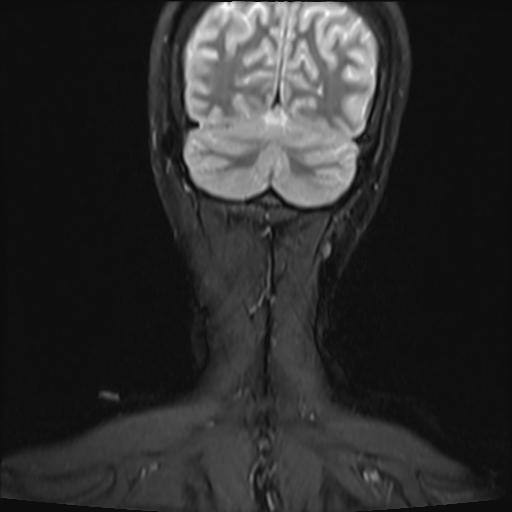 File:Bilateral carotid body tumors and right jugular paraganglioma (Radiopaedia 20024-20060 Coronal 49).jpg