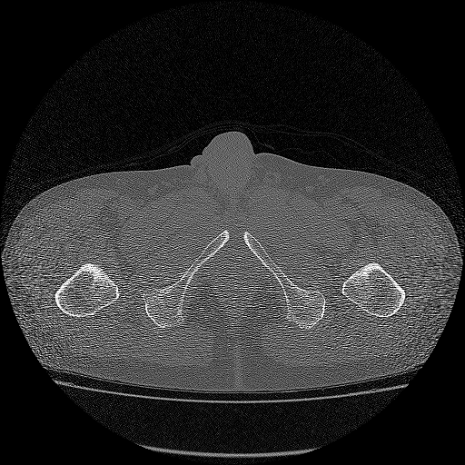Bilateral femoral neck stress fractures (Radiopaedia 28666-28954 Axial bone window 79).png