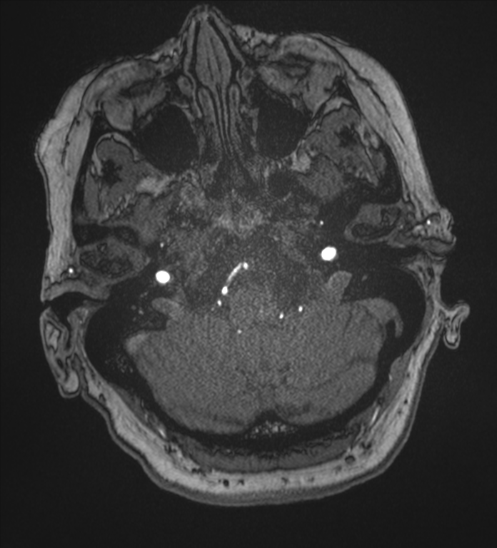 Bilateral fetal posterior communicating arteries (Radiopaedia 41286-44102 Axial MRA 20).png