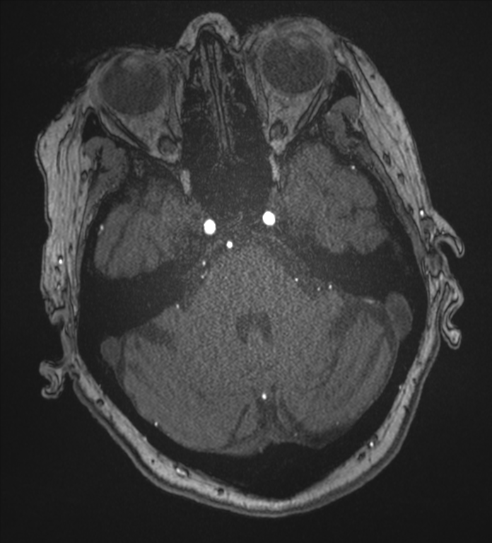 Bilateral fetal posterior communicating arteries (Radiopaedia 41286-44102 Axial MRA 49).png