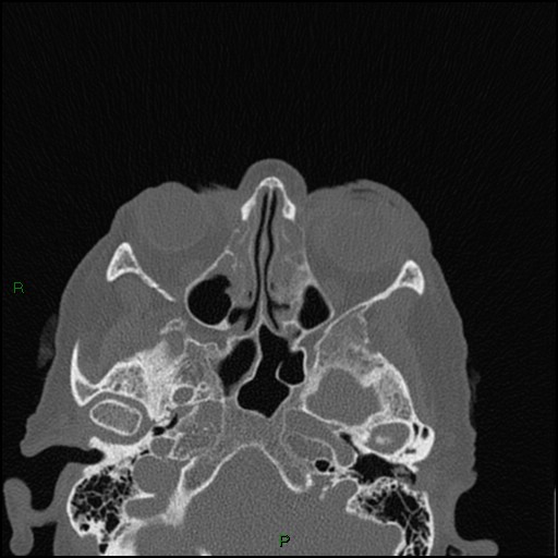 File:Bilateral frontal mucoceles (Radiopaedia 82352-96454 Axial bone window 160).jpg