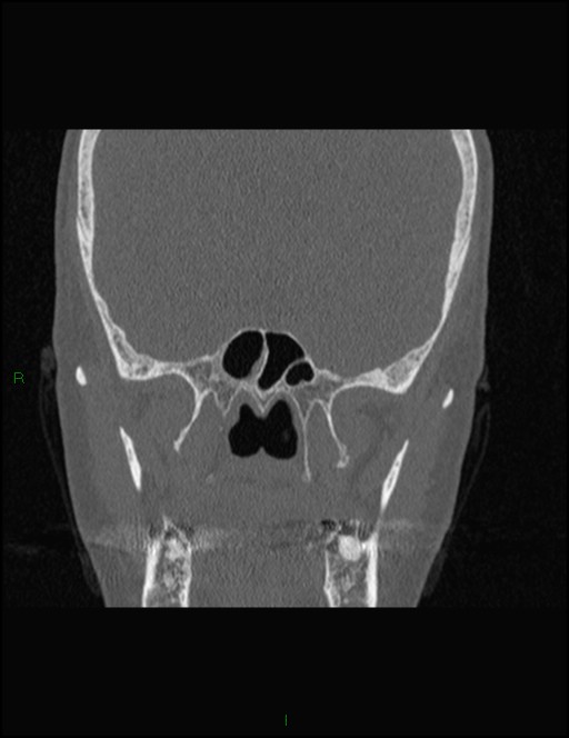 Bilateral frontal mucoceles (Radiopaedia 82352-96454 Coronal 226).jpg