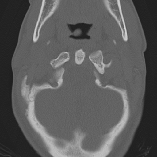 Bilateral locked facets (Radiopaedia 33850-35016 Axial bone window 6).png