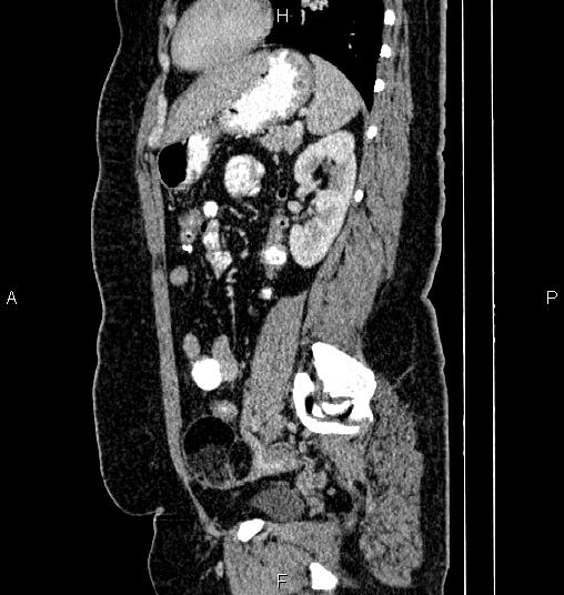 File:Bilateral ovarian dermoid cysts (Radiopaedia 85785-101603 D 64).jpg