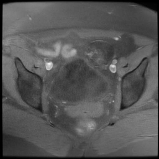 File:Bilateral ovarian dermoid cysts (Radiopaedia 90152-107338 Axial T1 fat sat 13).jpg