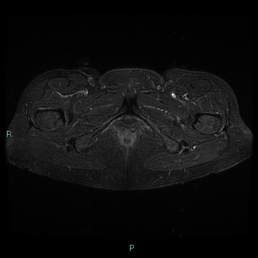 File:Bilateral ovarian fibroma (Radiopaedia 44568-48293 Axial STIR 29).jpg