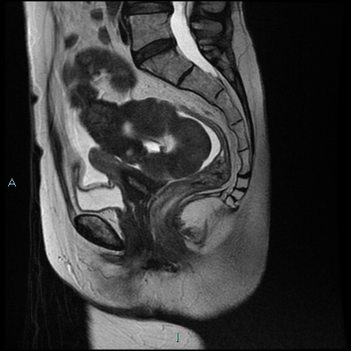 File:Bilateral ovarian fibroma (Radiopaedia 44568-48293 Sagittal T2 18).jpg