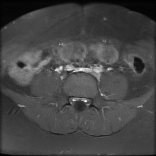 File:Bilateral ovarian fibrothecomas - adolescent (Radiopaedia 86604-102707 Axial T1 C+ fat sat 1).jpg