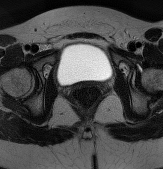 File:Bilateral ovarian fibrothecomas - adolescent (Radiopaedia 86604-102707 Axial T2 38).jpg