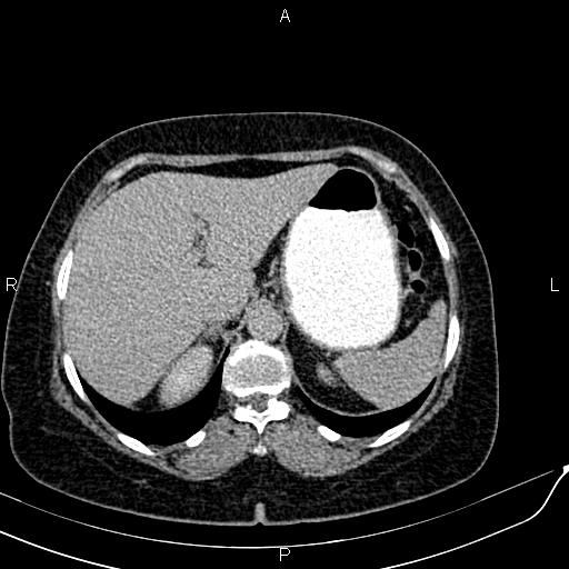 Bilateral ovarian serous cystadenocarcinoma (Radiopaedia 86062-101989 Axial C+ delayed 7).jpg