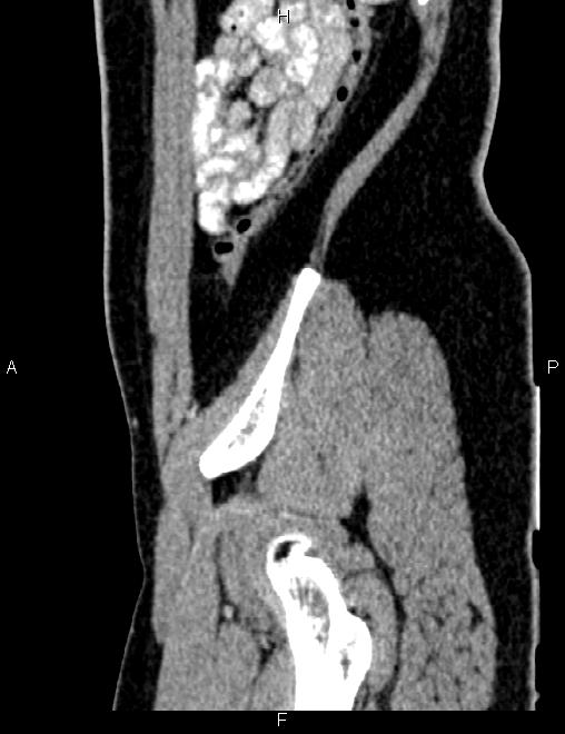 Bilateral ovarian teratoma (Radiopaedia 83131-97503 D 95).jpg