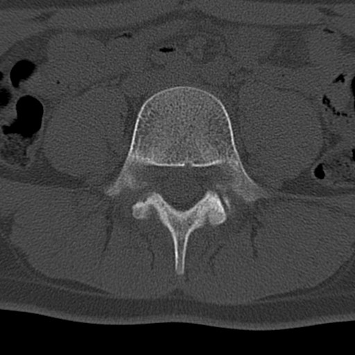 Bilateral pars defect (Radiopaedia 26691-26846 Axial bone window 32).jpg
