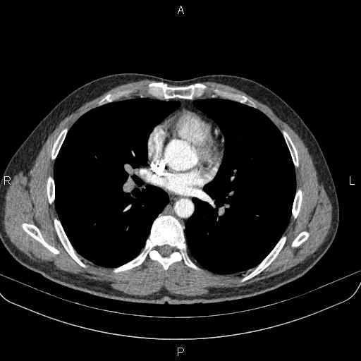 Bilateral pulmonary AVM (Radiopaedia 83134-97505 A 40).jpg
