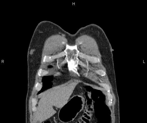 Bilateral pulmonary AVM (Radiopaedia 83134-97505 C 10).jpg