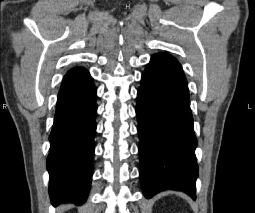 Bilateral pulmonary AVM (Radiopaedia 83134-97505 C 65).jpg
