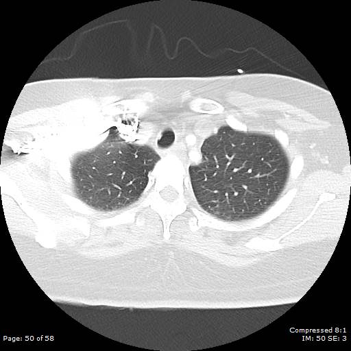 Bilateral pulmonary emboli with Hampton hump sign (Radiopaedia 54070-60246 Axial lung window 50).jpg