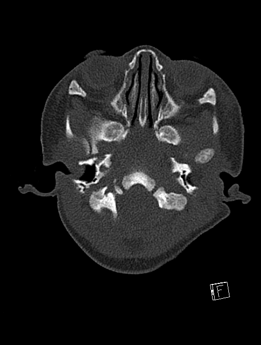 Bilateral subdural hemorrhage and parietal skull fracture (Radiopaedia 26058-26192 Axial bone window 116).png