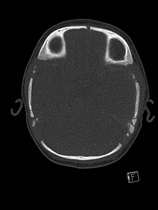 Bilateral subdural hemorrhage and parietal skull fracture (Radiopaedia 26058-26192 Axial bone window 93).png