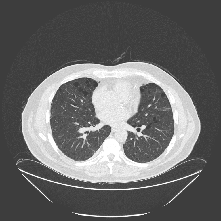 Birt-Hogg-Dubé syndrome (Radiopaedia 52578-58491 Axial lung window 35).jpg