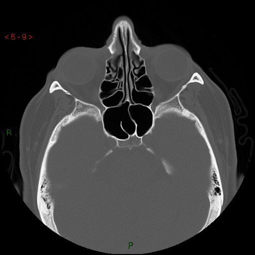 File:Bisphosphonate-related osteonecrosis of the jaw (Radiopaedia 54147-60329 Axial bone window 3).jpg