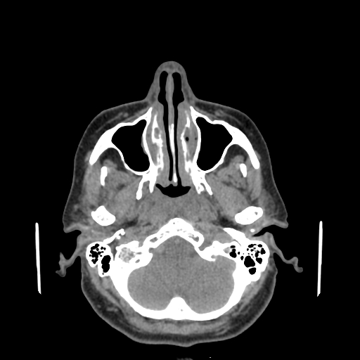 File:Bisphosphonate-related osteonecrosis of the jaw (Radiopaedia 71324-81642 non-contrast 139).jpg