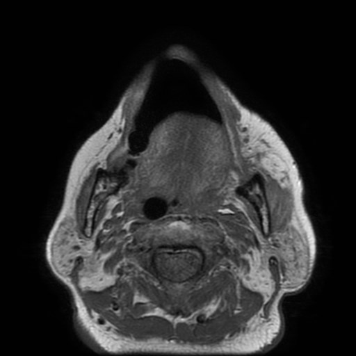 Bisphosphonate-related osteonecrosis of the maxilla (Radiopaedia 51367-57101 Axial T1 15).jpg