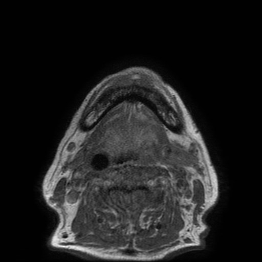 Bisphosphonate-related osteonecrosis of the maxilla (Radiopaedia 51367-57101 Axial T1 4).jpg