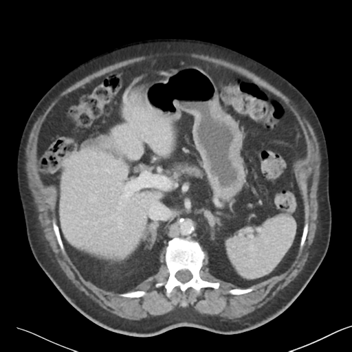 File:Bladder papillary urothelial carcinoma (Radiopaedia 48119-52951 Axial 13).png